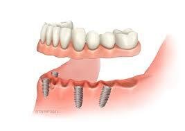 Fixed teeth in Mayur Vihar Phase-3