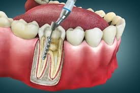 Root Canal Treatment in Delhi West