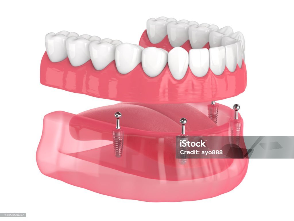 Best Partial Denture Treatment in Mayur Vihar