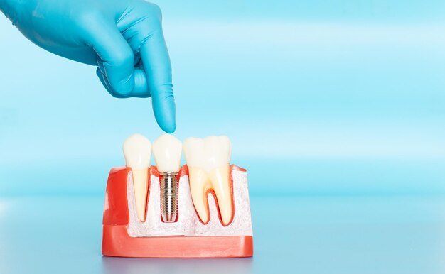 Best Root Canal Treatment in Mayur Vihar