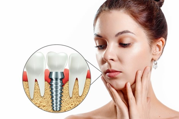 Best Dental Implants in Mayur Vihar 3