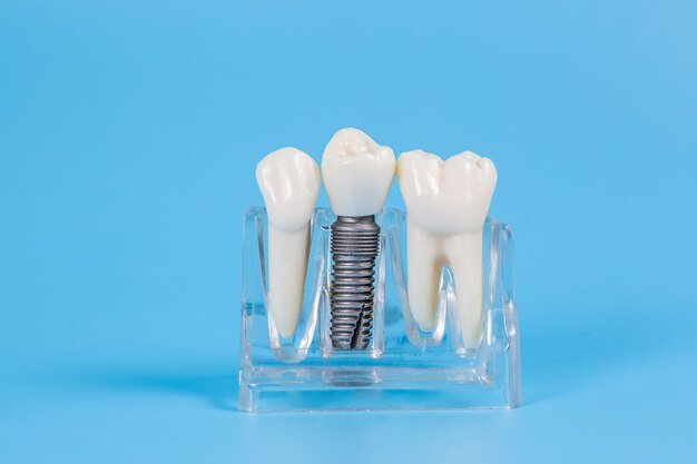 Expert Dental implant in Mayur Vihar