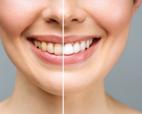 Best Teeth Whitening Services in Ashok Vihar