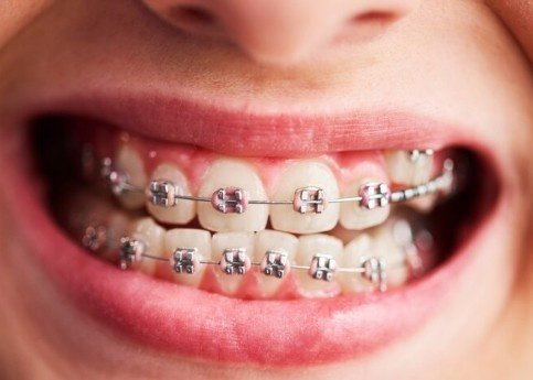 Best Orthodontic Wire Treatment in Ashok Vihar