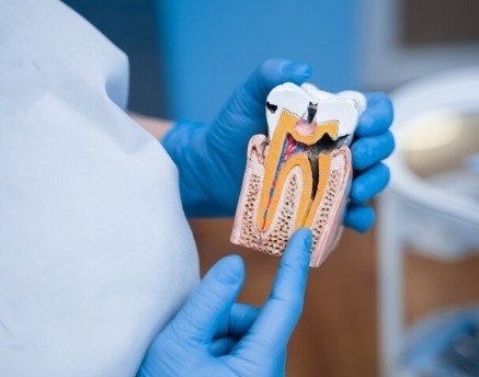 Best Root Canal Treatment in Ashok Vihar