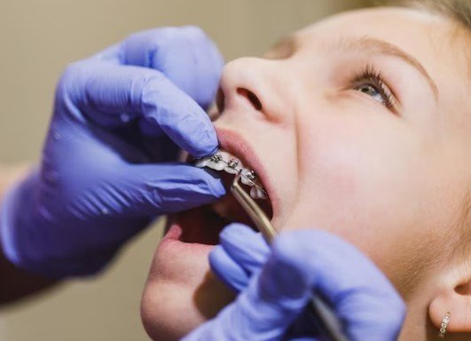 Best Orthodontic Wire Treatment in New Ashok Nagar