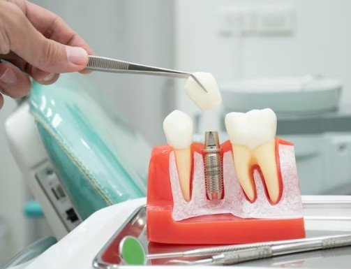 Best Dental Implant Service in Noida