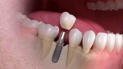 Best Dental Implant New Delhi