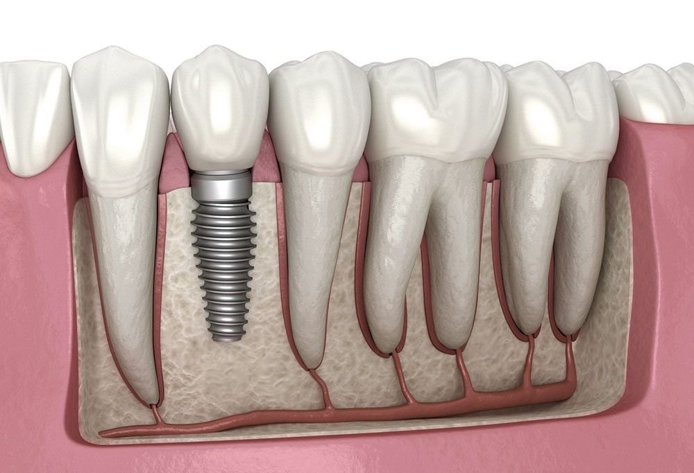 Best Dental Implant in New Delhi