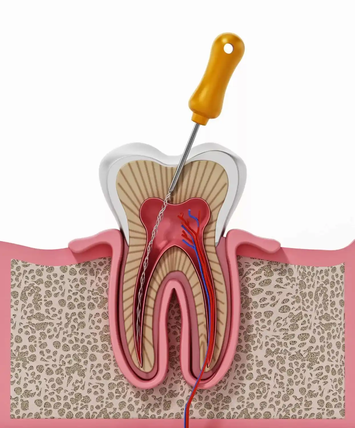 Best Root Canal Treatment in New Delhi