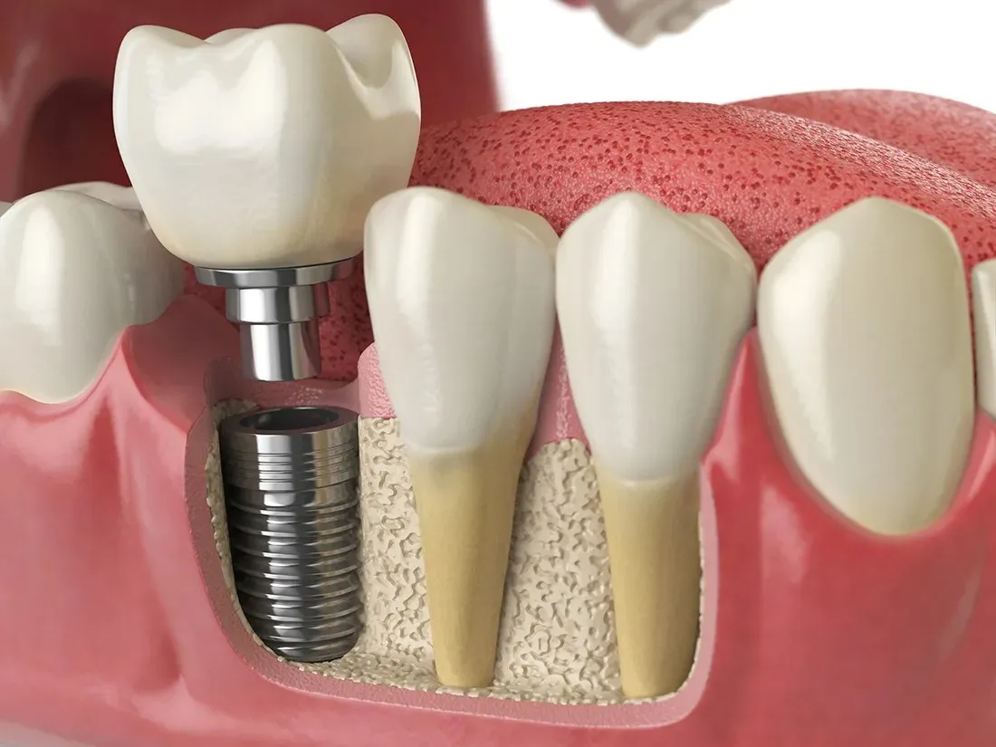 Best Dental Implant in New Delhi