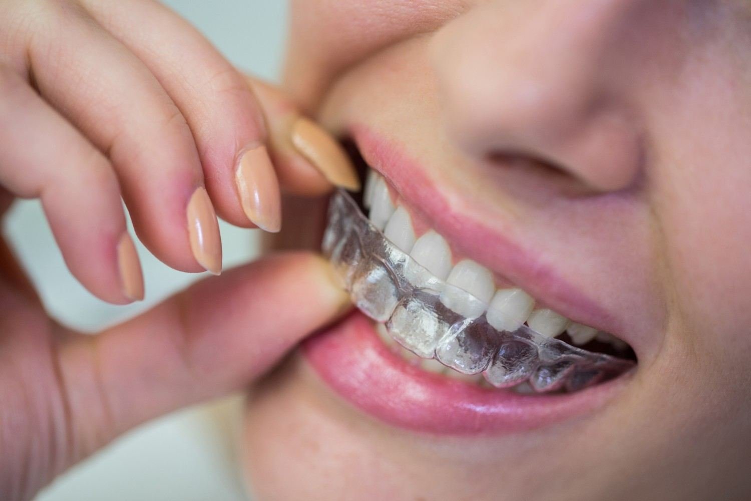 Invisalign Treatment in Mayur Vihar