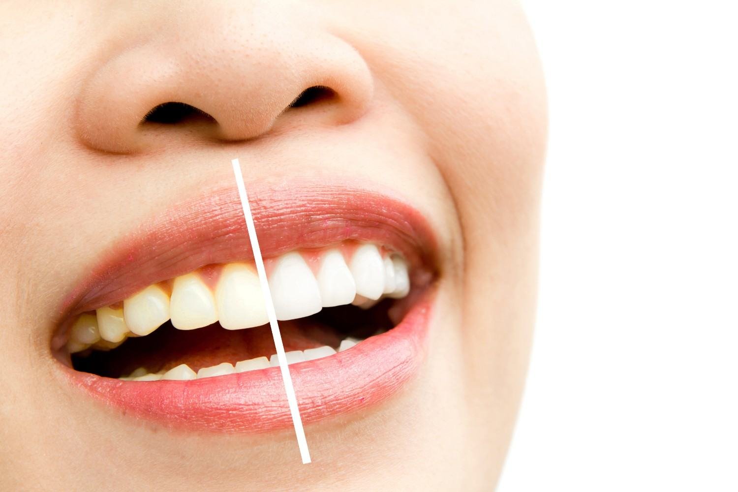 Teeth Whitening in Mayur Vihar