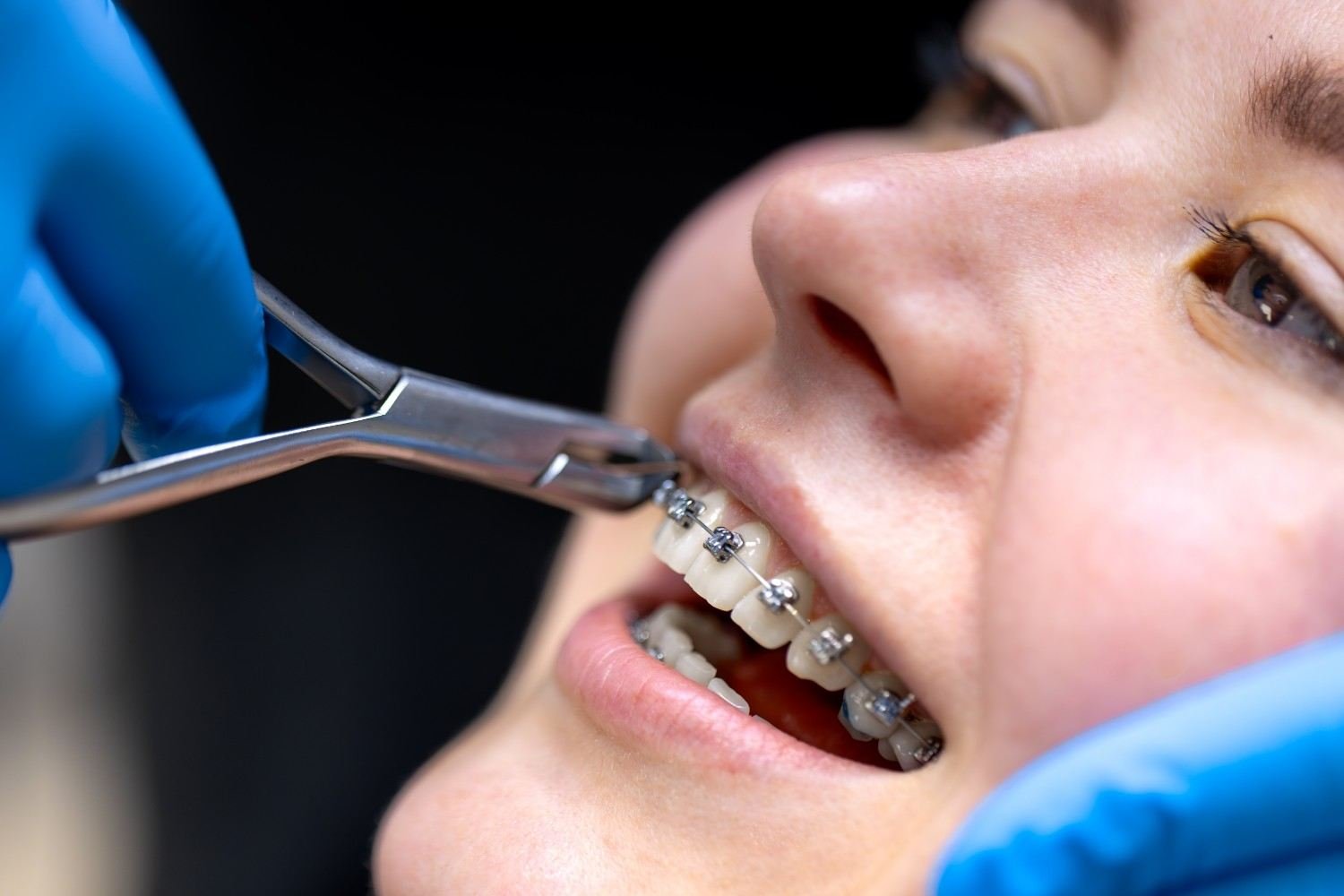 Braces Treatment in Mayur Vihar