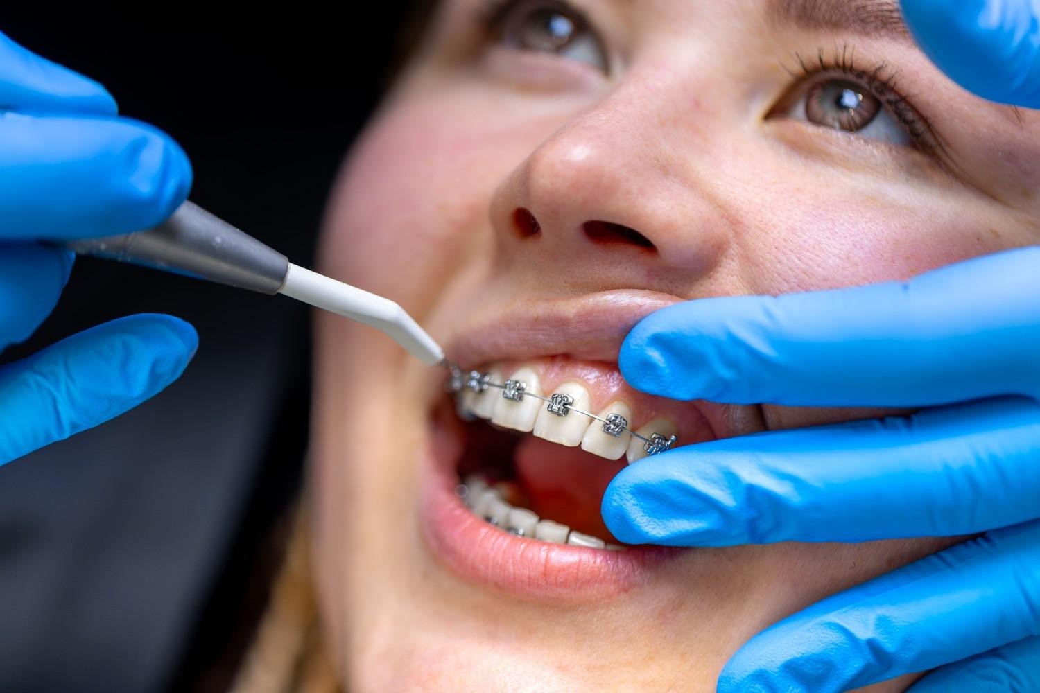 Orthodontic Treatment in Mayur Vihar