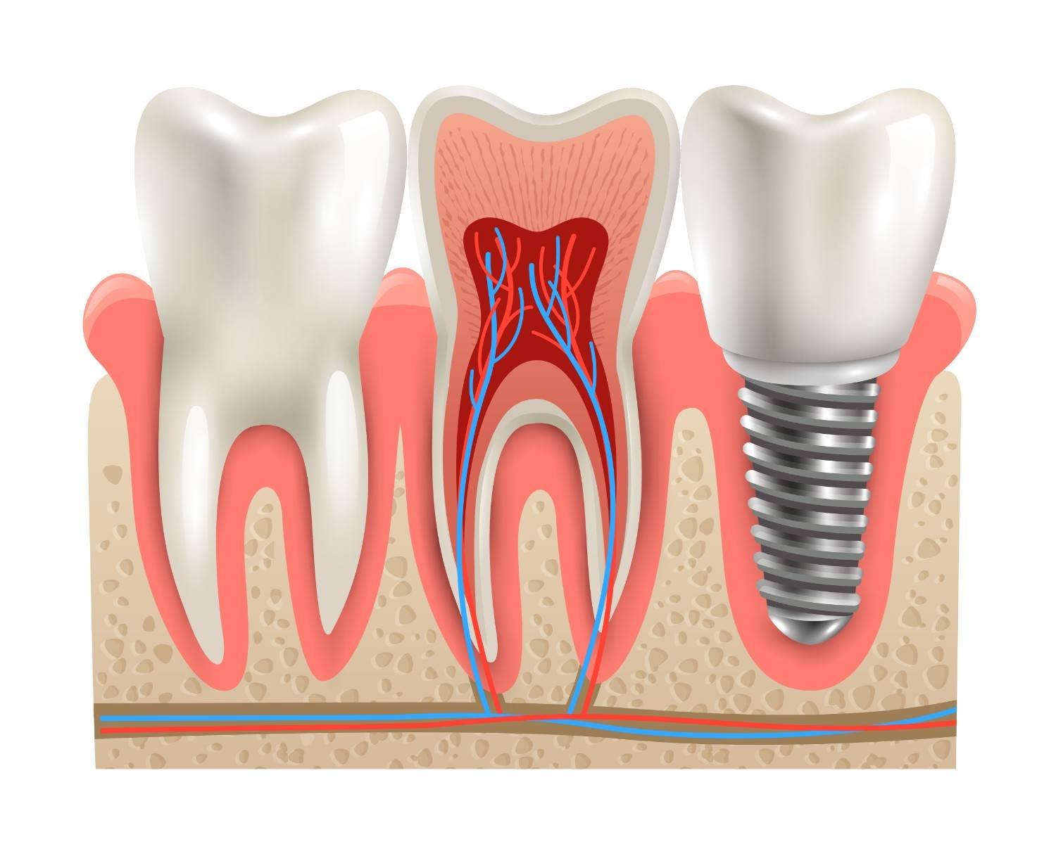 Dental Implants in Mayur Vihar